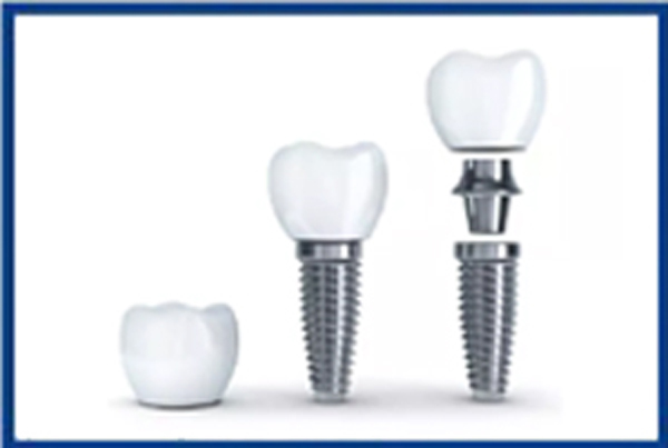 Dental Implants